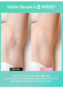 IPL Laser Hair Removal Device – Professional Home Epilator